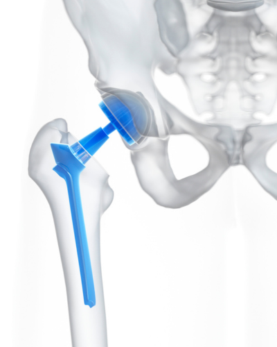 Hip replacement