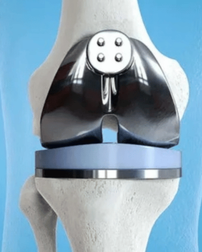 Knee Replacement