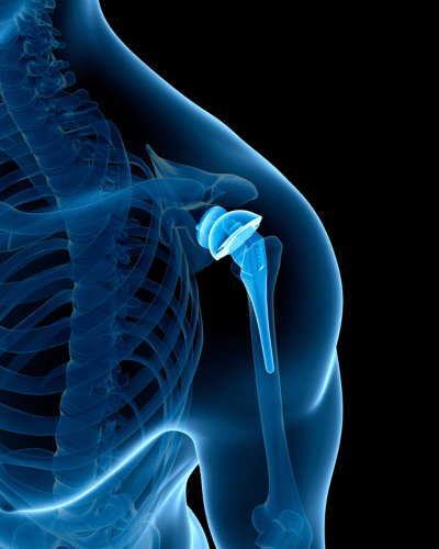 Shoulder Replacement