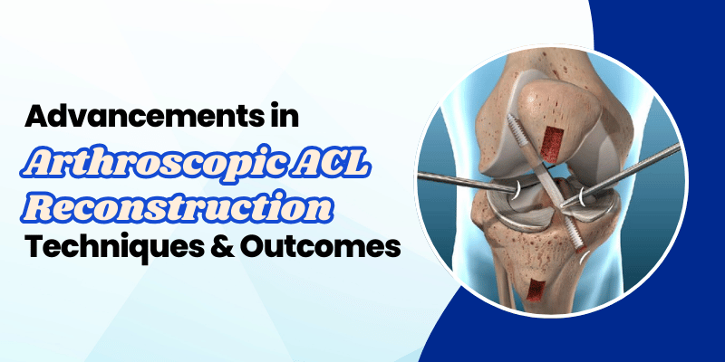 Advancements in Arthroscopic ACL Reconstruction Techniques & Outcomes