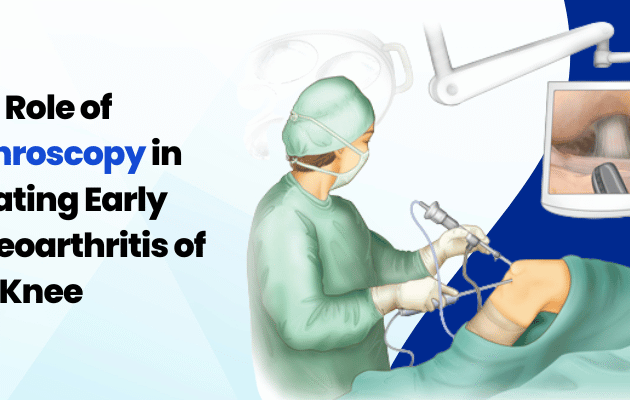The Role of Arthroscopy in Treating Early Osteoarthritis of the Knee