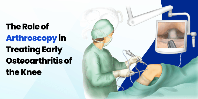 The Role of Arthroscopy in Treating Early Osteoarthritis of the Knee